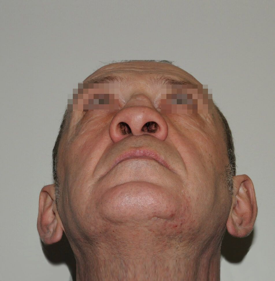 До операции До операции