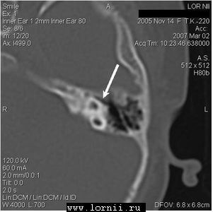 Рис. 3. Расширенная и деформированная система полукружных каналов слева Рис. 3. Расширенная и деформированная система полукружных каналов слева