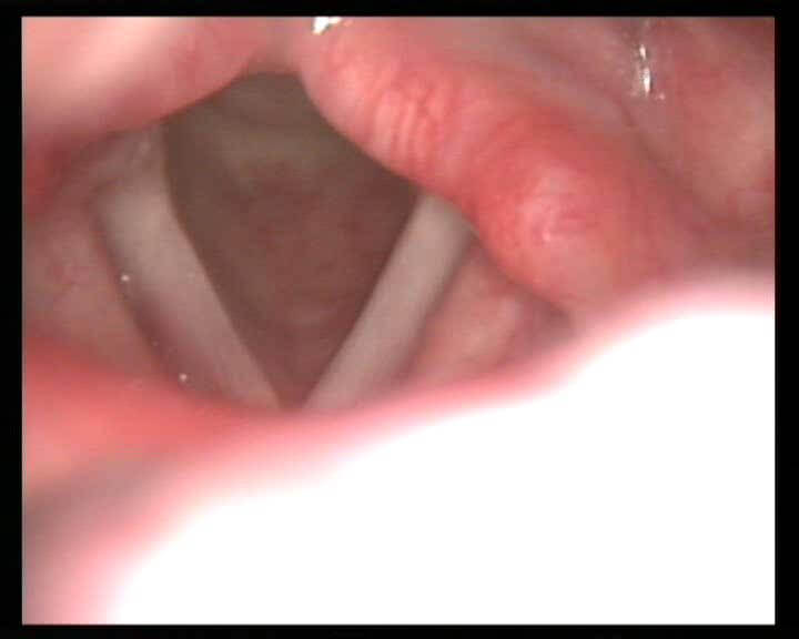 Рис 1 Видеоэндоскопия и аутофлюоресцентная эндоскопия здоровой гортани (АFN) Рис 1 Видеоэндоскопия и аутофлюоресцентная эндоскопия здоровой гортани (АFN)
