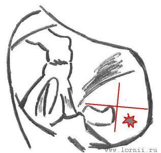 Рис. 1. Наложение каудальной кохлеостомы. Примечание: Две перпендикулярные линии проходят по верхнему и переднему краю ниши окна улитки. Звездочкой обозначено место наложения кохлеостомы. Рис. 1. Наложение каудальной кохлеостомы. Примечание: Две перпендикулярные линии проходят по верхнему и переднему краю ниши окна улитки. Звездочкой обозначено место наложения кохлеостомы.