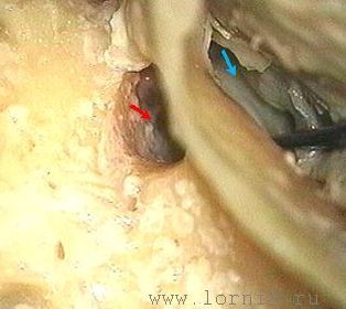 Рис. 3. Моделирование комбинированного подхода на препарате височной кости. Примечание: (красная стрелка) подход к барабанной полости через заднюю тимпаностому; (синяя стрелка) тимпанотомия через НСП Рис. 3. Моделирование комбинированного подхода на препарате височной кости. Примечание: (красная стрелка) подход к барабанной полости через заднюю тимпаностому; (синяя стрелка) тимпанотомия через НСП