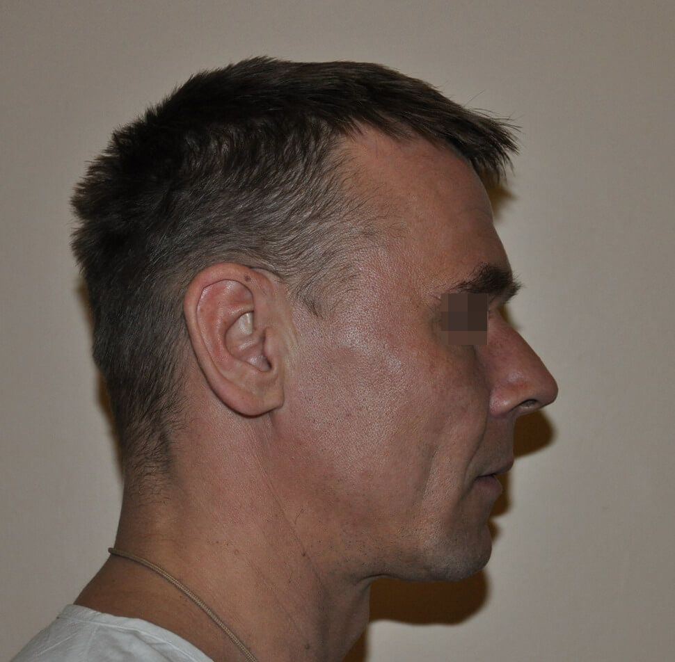 До операции До операции