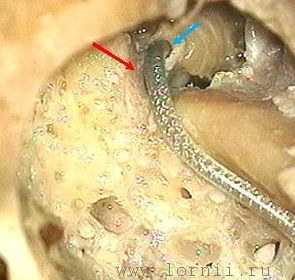 Рис. 4. Создание бороздки над лицевым нервом, укладка активного электрода. Примечание: (красная стрелка)  бороздка для электрода; (синяя стрелка)  кохлеостома Рис. 4. Создание бороздки над лицевым нервом, укладка активного электрода. Примечание: (красная стрелка)  бороздка для электрода; (синяя стрелка)  кохлеостома