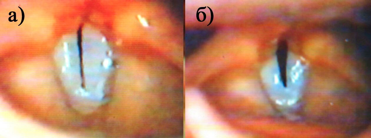 Рис.5. Гортань девочки С., 14 лет в период мутации при фонации в головном (а) и грудном (б) регистре Рис.5. Гортань девочки С., 14 лет в период мутации при фонации в головном (а) и грудном (б) регистре