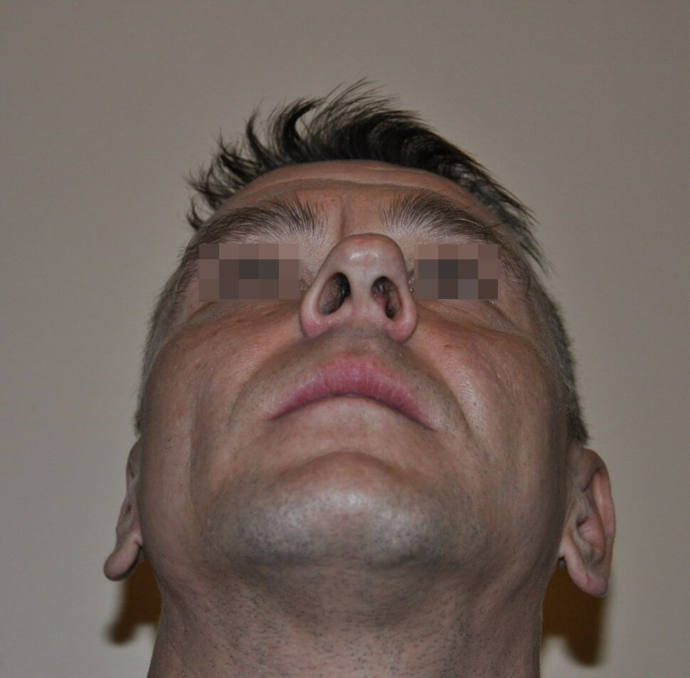 До операции До операции