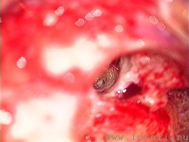 Рис.13. Ниша окна улитки Рис.13. Ниша окна улитки