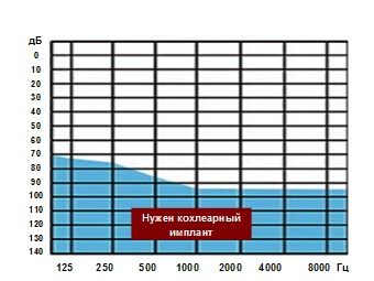 Рисунок 1. Зона аудиограмм, при которой пациенту рекомендуется кохлеарная имплантация Рисунок 1. Зона аудиограмм, при которой пациенту рекомендуется кохлеарная имплантация