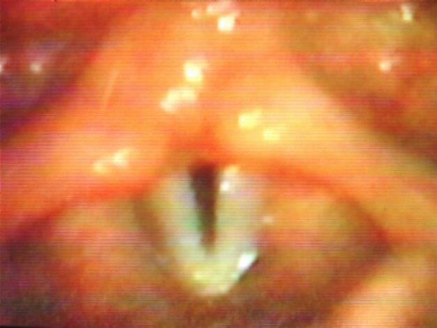 Рис.9. Треугольная щель при функциональной афонии  у больной П., 10 лет Рис.9. Треугольная щель при функциональной афонии  у больной П., 10 лет