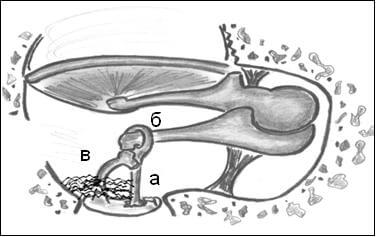 Рис.2. Рубцовые конгломераты в области неполностью удаленных суперструктур стремени. Примечание:  а – тефлоновый протез, б – длинная ножка наковальни, в – частично сохраненные головка и ножки стремени, рубцовые спайки в окне преддверия. Рис.2. Рубцовые конгломераты в области неполностью удаленных суперструктур стремени. Примечание:  а – тефлоновый протез, б – длинная ножка наковальни, в – частично сохраненные головка и ножки стремени, рубцовые спайки в окне преддверия.
