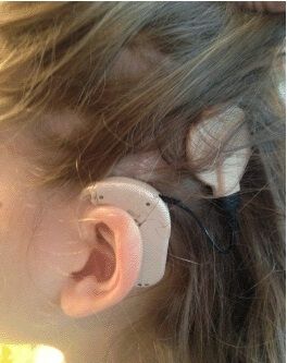 Рисунок 2. Внешняя и имплантируемая части кохлеарного импланта. Расположение внешней части кохлеарного импланта на голове пациента Рисунок 2. Внешняя и имплантируемая части кохлеарного импланта. Расположение внешней части кохлеарного импланта на голове пациента