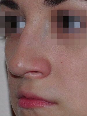 До операции До операции