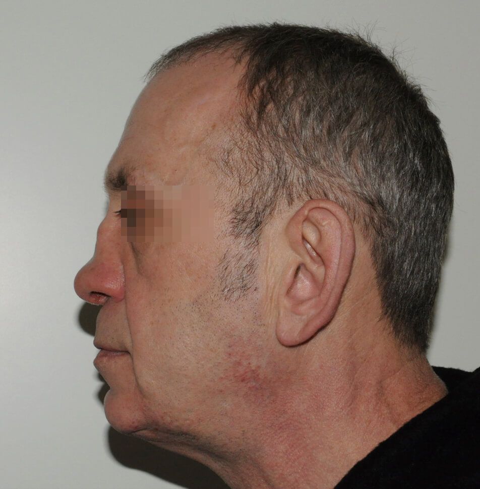 До операции До операции