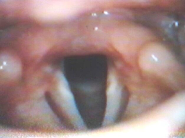 Рис. 7. Зияние гортанных желудочков как симптом гипотонусной дисфонии у больного С., 10 лет Рис. 7. Зияние гортанных желудочков как симптом гипотонусной дисфонии у больного С., 10 лет