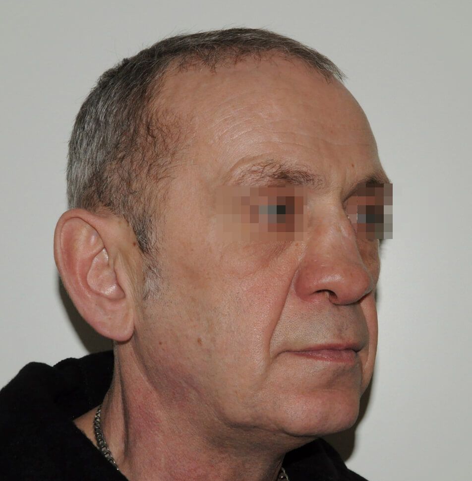 До операции До операции