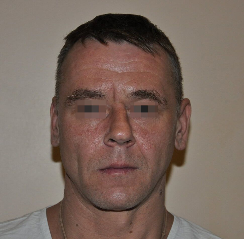 До операции До операции