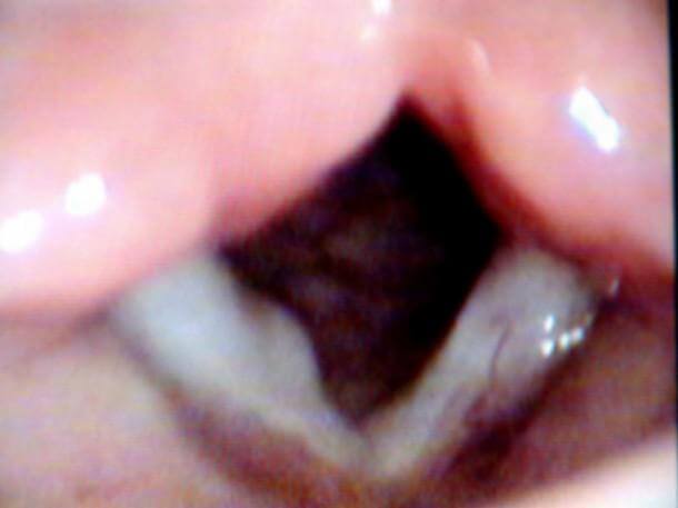 Рис. 5. Киста правой голосовой складки  у больного В., 10 лет Рис. 5. Киста правой голосовой складки  у больного В., 10 лет