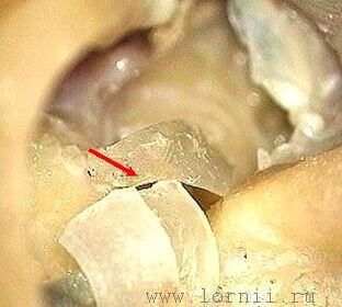 Рис. 5. Укладка фрагментов аутохряща над электродом. Примечание: (красная стрелка)  полоски аутохряща. Рис. 5. Укладка фрагментов аутохряща над электродом. Примечание: (красная стрелка)  полоски аутохряща.