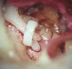 Рис.4. Замена тефлоного протеза.  (левое ухо) Рис.4. Замена тефлоного протеза.  (левое ухо)