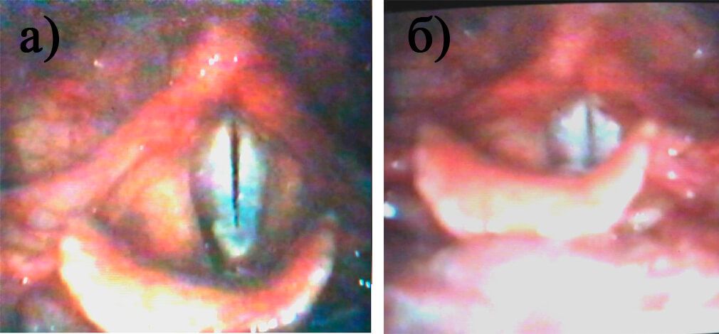 Рис. 6. Гортань девочки М., 15 лет в постмутационном периоде при фонации в головном (а) и грудном (б) регистре Рис. 6. Гортань девочки М., 15 лет в постмутационном периоде при фонации в головном (а) и грудном (б) регистре