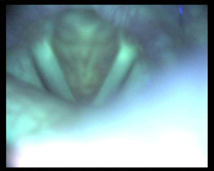 Рис 2 Видеоэндоскопия и аутофлюоресцентная эндоскопия гортани пациента с хроническим гиперпластическим ларингитом (AF-) Рис 2 Видеоэндоскопия и аутофлюоресцентная эндоскопия гортани пациента с хроническим гиперпластическим ларингитом (AF-)