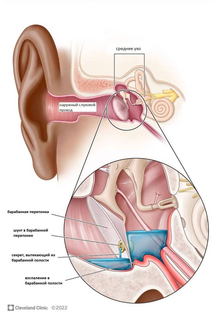 Шунт устанавливается в барабанной перепонке Шунт устанавливается в барабанной перепонке