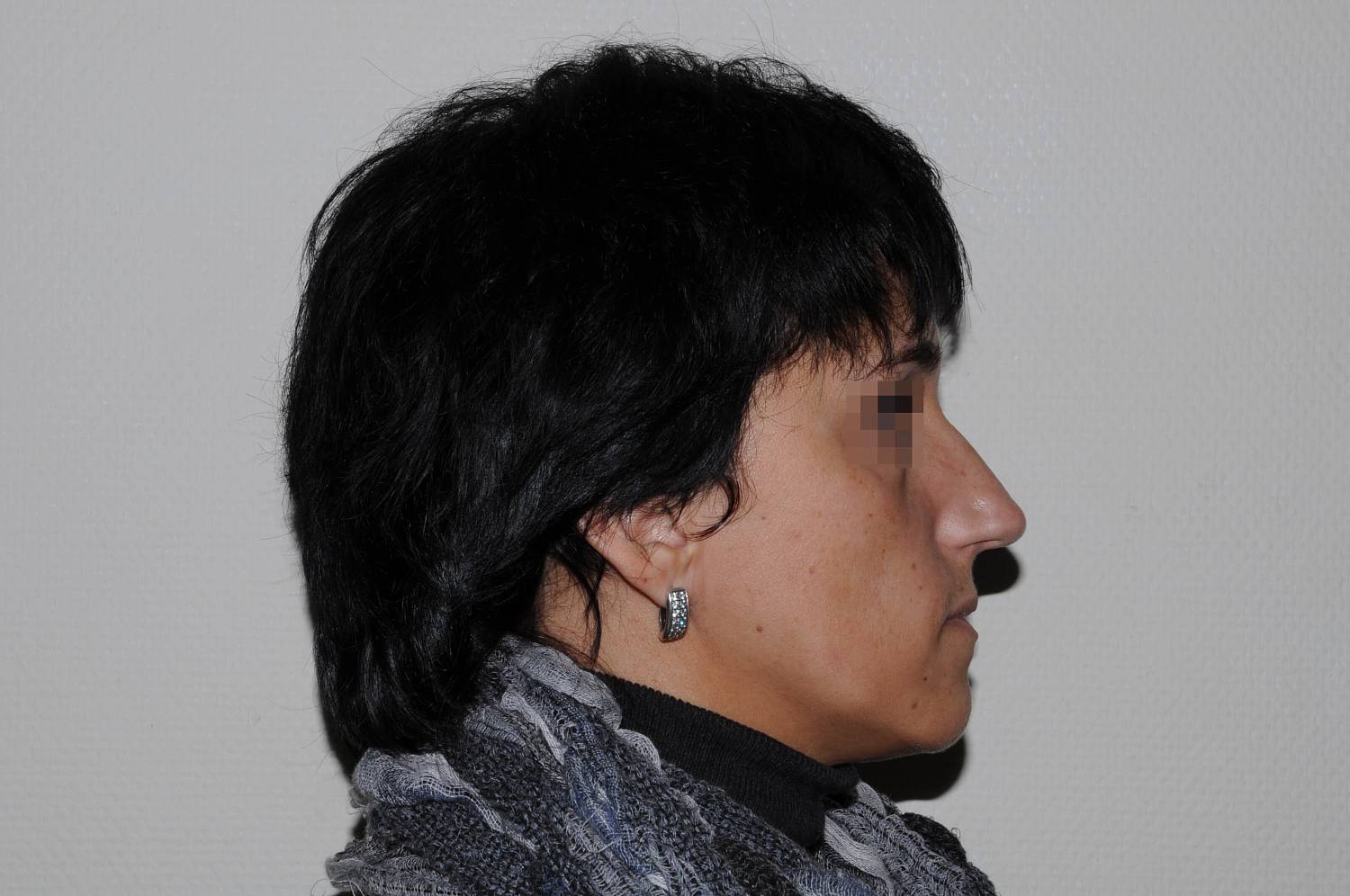 До операции До операции