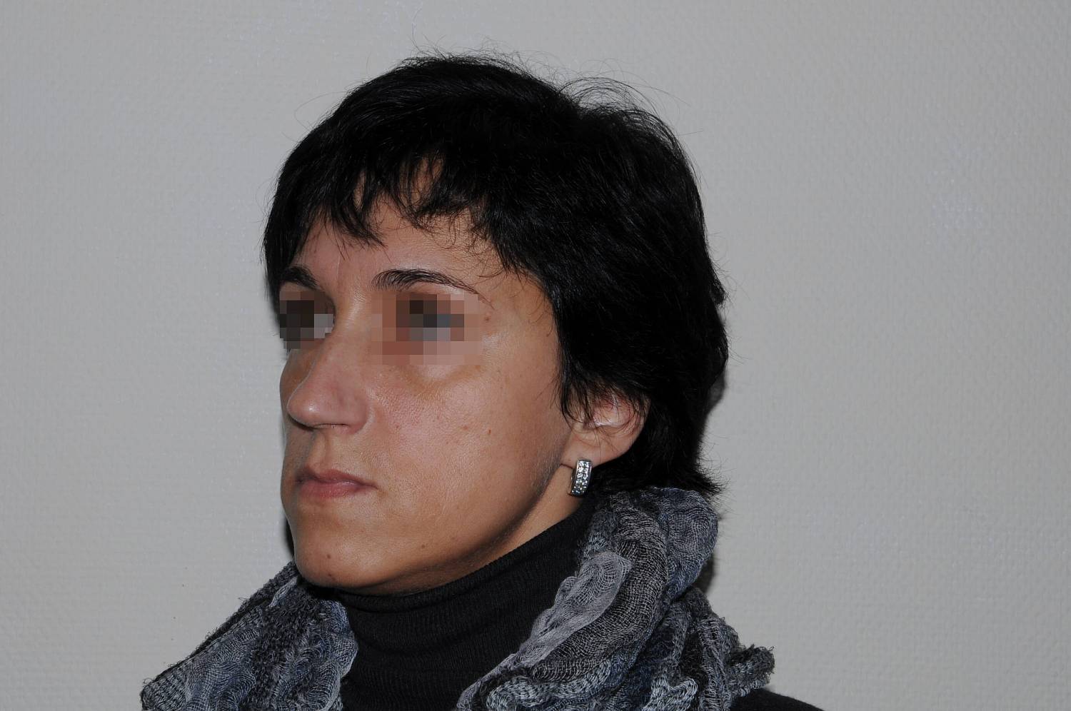 До операции До операции