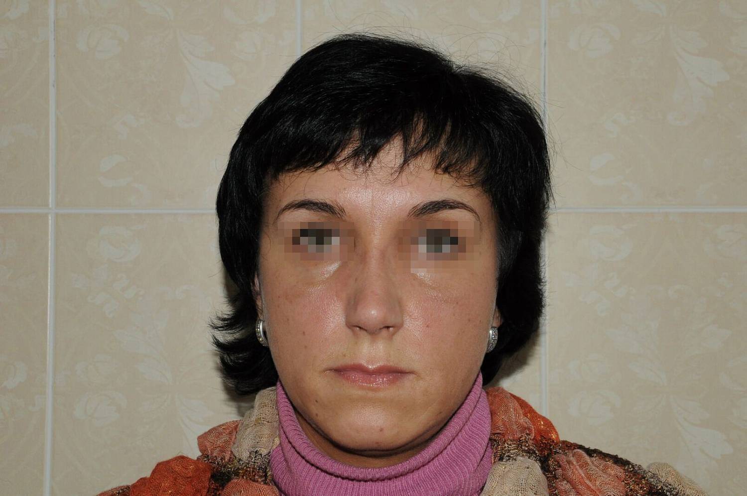 После операции После операции