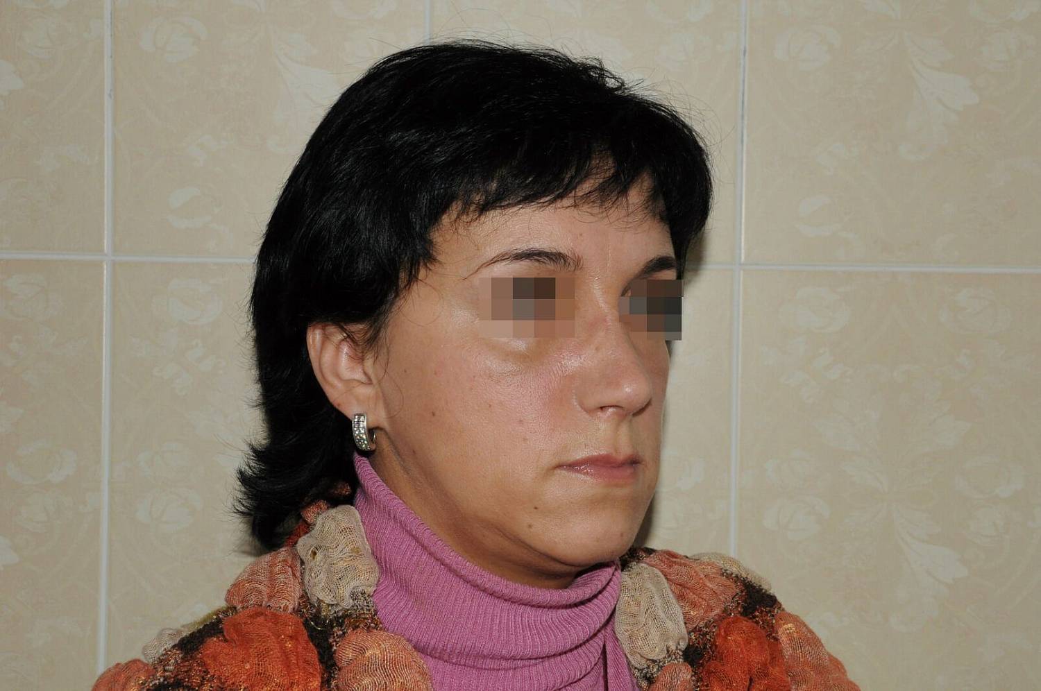 После операции После операции