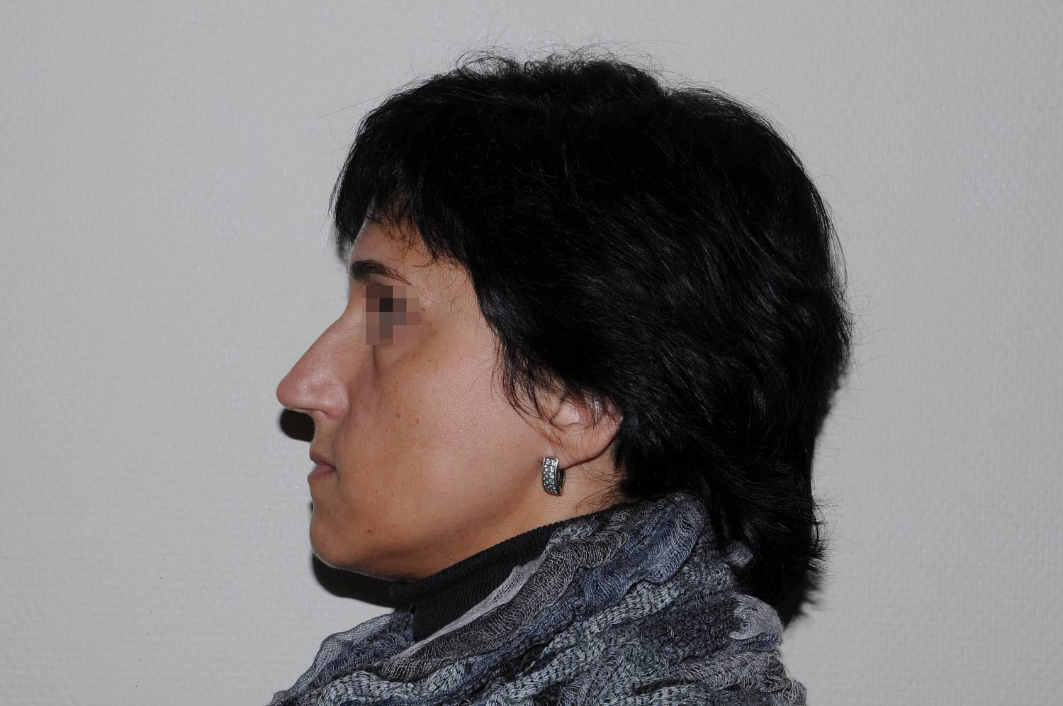 До операции До операции