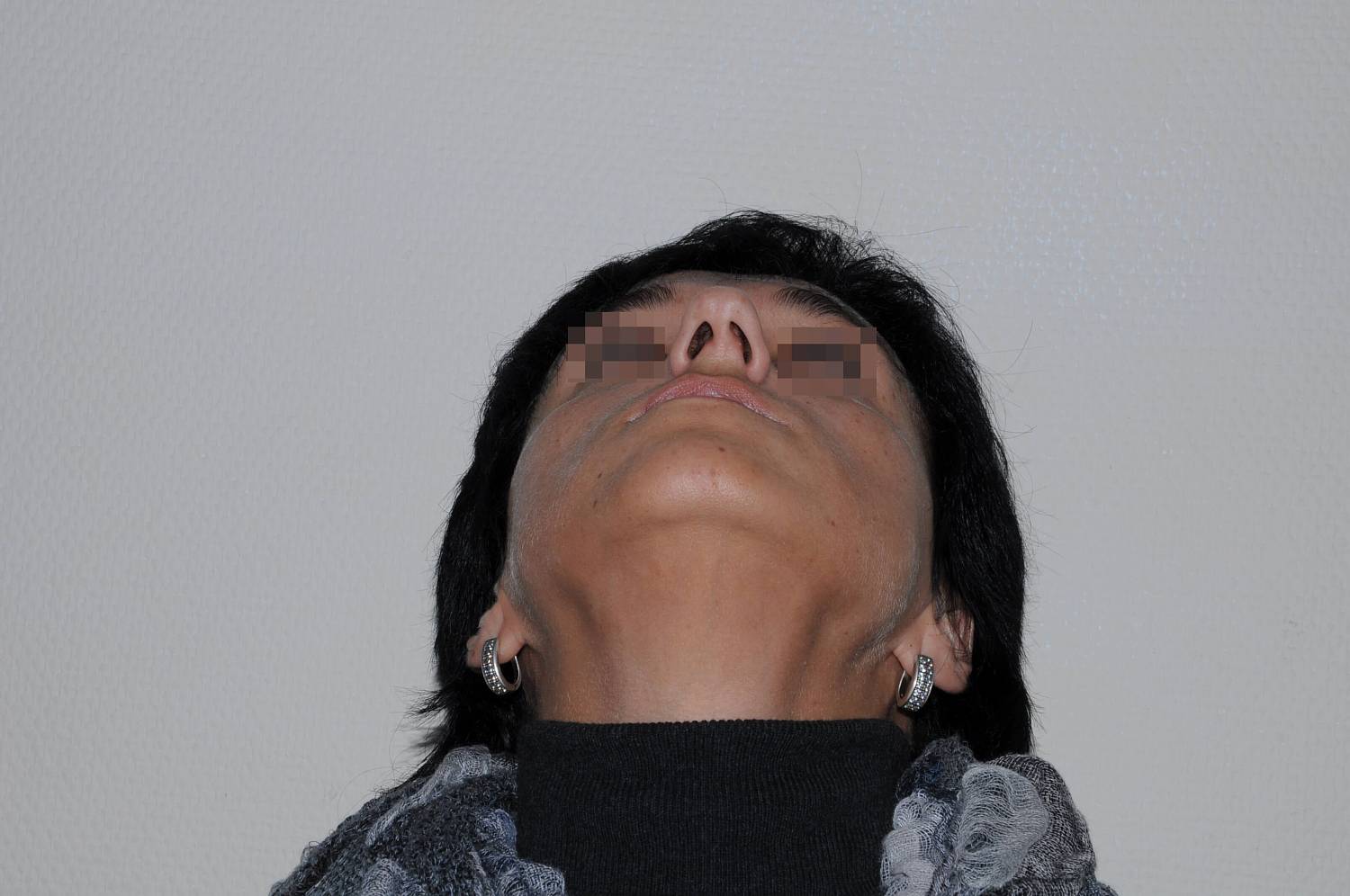 До операции До операции