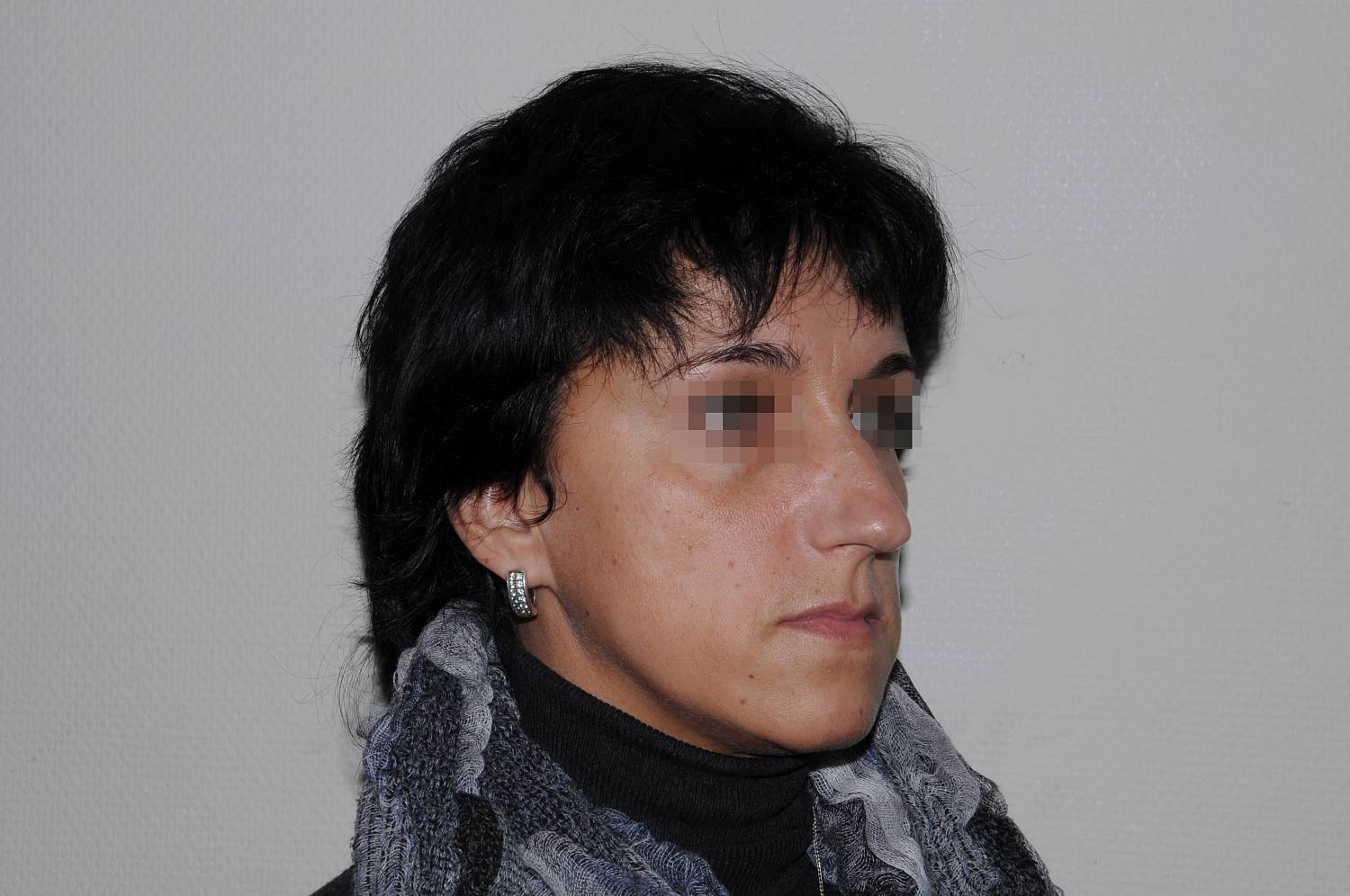 До операции До операции